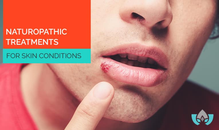 Naturopathic Treatments For Skin Conditions | Mindful Healing | Naturopathic Doctor Mississauga